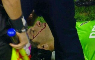 Orión atingido por projéctil, actua 90 minutos com corte na cabeça